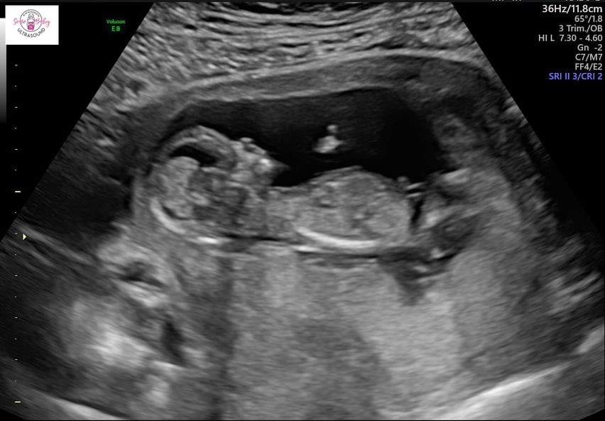 13 week fetus ultra sound